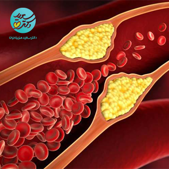 معجون بازکننده عروق