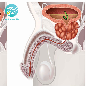 قرص پروستات